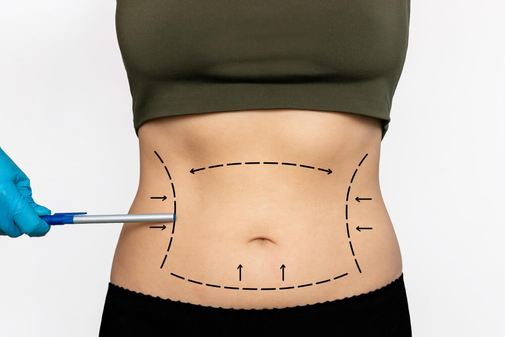 Schéma chirurgical montrant une abdominoplastie, exemple de lipoadipectomie de l'abdomen.