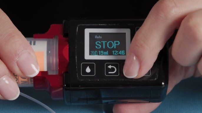 Pompe à Apomorphine (Apokinon) portée par un patient