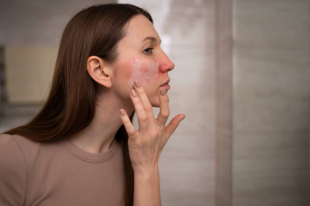 Roaccutane fait grossir : Mythe ou effet secondaire réel ? 3