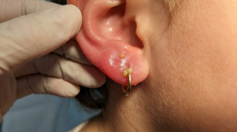 Accueil 1 Lobe d'oreille d'enfant rouge et gonflé autour de la boucle d'oreille, signe d'infection bactérienne
