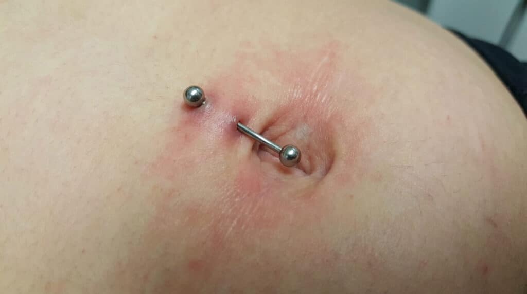 Piercing au nombril montrant des signes de rejet avec une peau amincie et une barre devenue trop longue visible