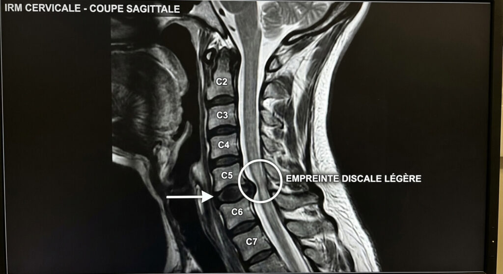 Coupe sagittale d'une IRM cervicale montrant une légère empreinte discale sur le cordon médullaire