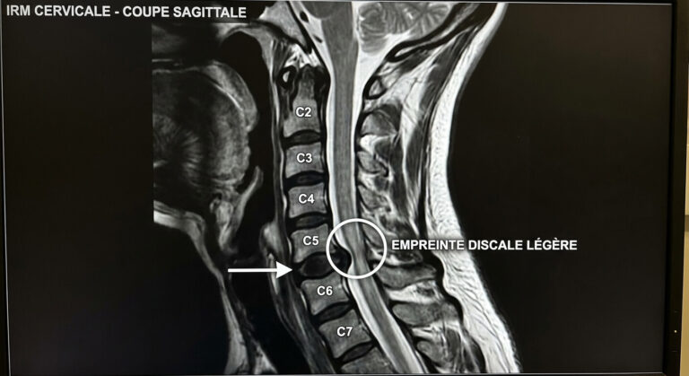 Coupe sagittale d'une IRM cervicale montrant une légère empreinte discale sur le cordon médullaire