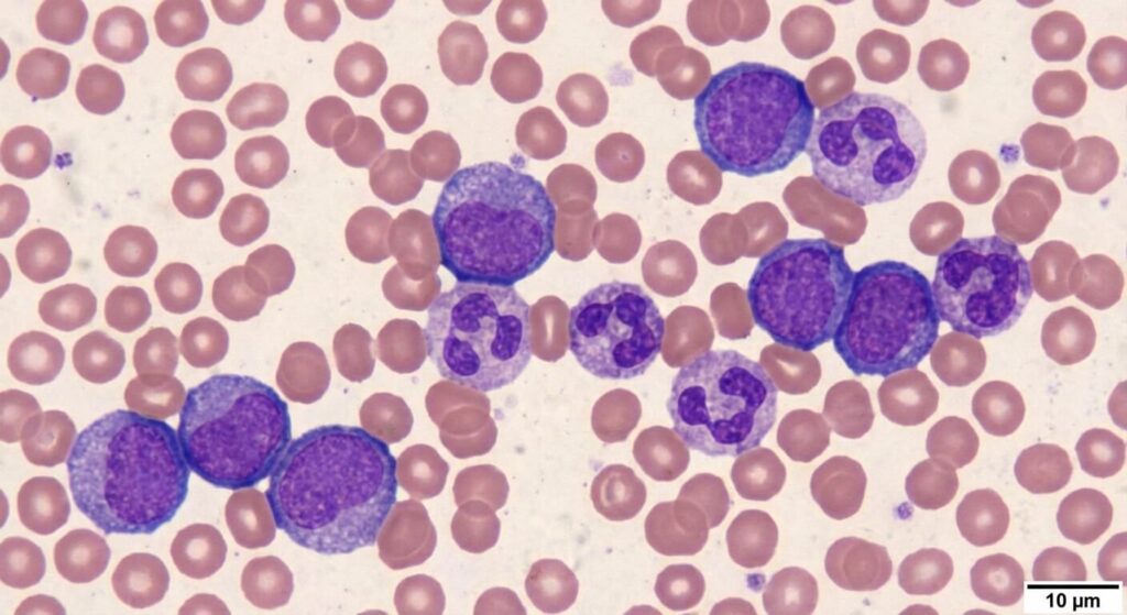 Analyse hématologique au microscope révélant la présence physiologique de cellules sanguines immatures