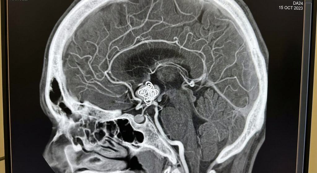 Maux de tête après une embolisation cérébrale : Est-ce normal ? 3 Imagerie artériographique du cerveau montrant un anévrisme traité par l'insertion de petits ressorts en platine