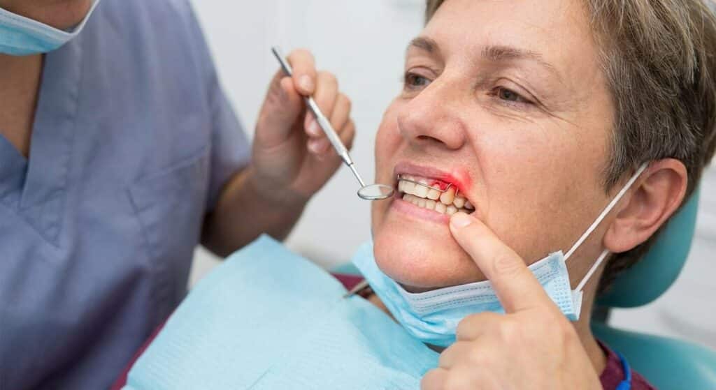 Patient montrant une irritation de la gencive causée par un appareil dentaire mal ajusté