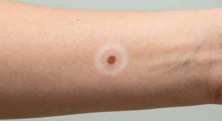 Grain de beauté entouré d'un cercle blanc dépigmenté (Halo naevus)