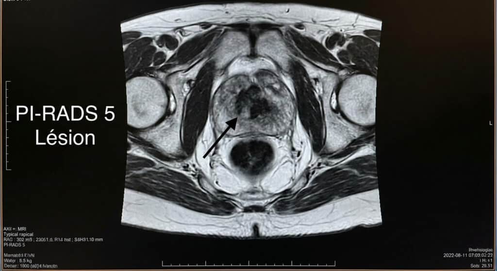 Image IRM de la prostate montrant une lésion classée PI-RADS 5 (très suspecte)