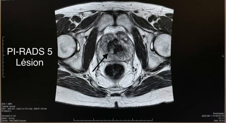 Image IRM de la prostate montrant une lésion classée PI-RADS 5 (très suspecte)