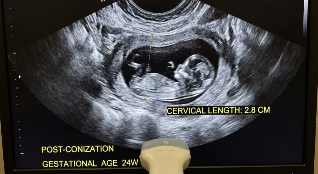 Échographie de mesure de la longueur du col chez une femme enceinte ayant eu une conisation
