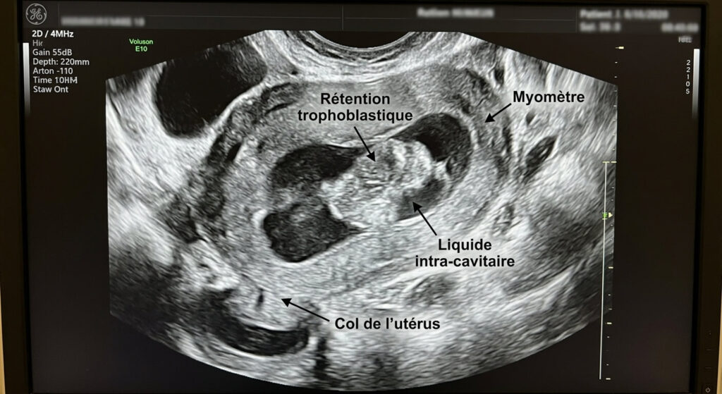 Débris lors d'une fausse couche : à quoi s'attendre et quand consulter 2 Vue échographique d'un utérus présentant une rétention trophoblastique.