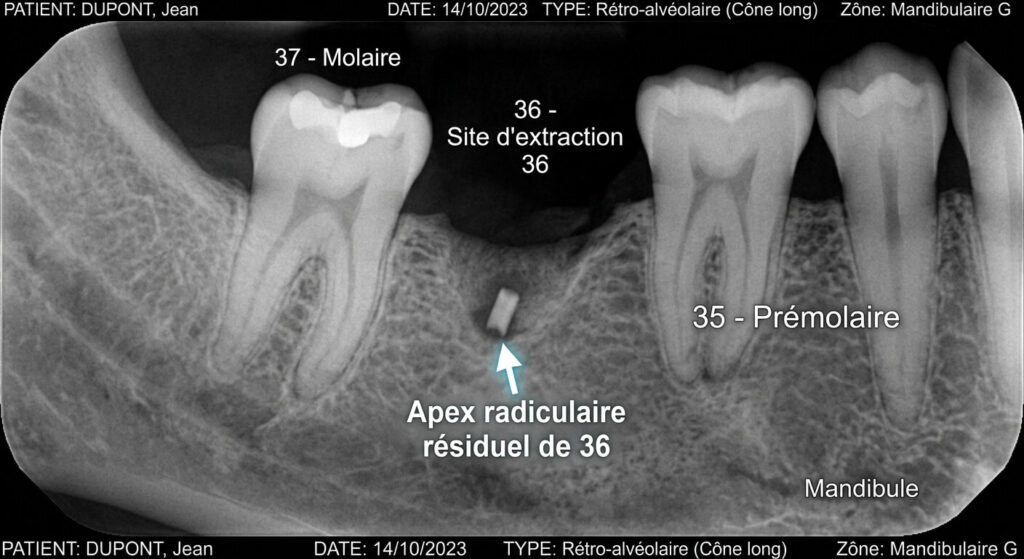 Radiographie dentaire montrant un apex radiculaire résiduel après une extraction complexe.