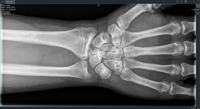 Accueil 1 Une radiographie médicale du poignet montrant une nécrose de l'os semi-lunaire.