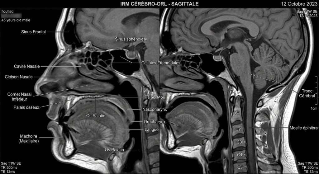 Otite séreuse chez l'adulte et lien avec le cancer : quand faut-il s'inquiéter ? 3 Une image médicale par résonance magnétique affichant les structures de la sphère ORL et des sinus.