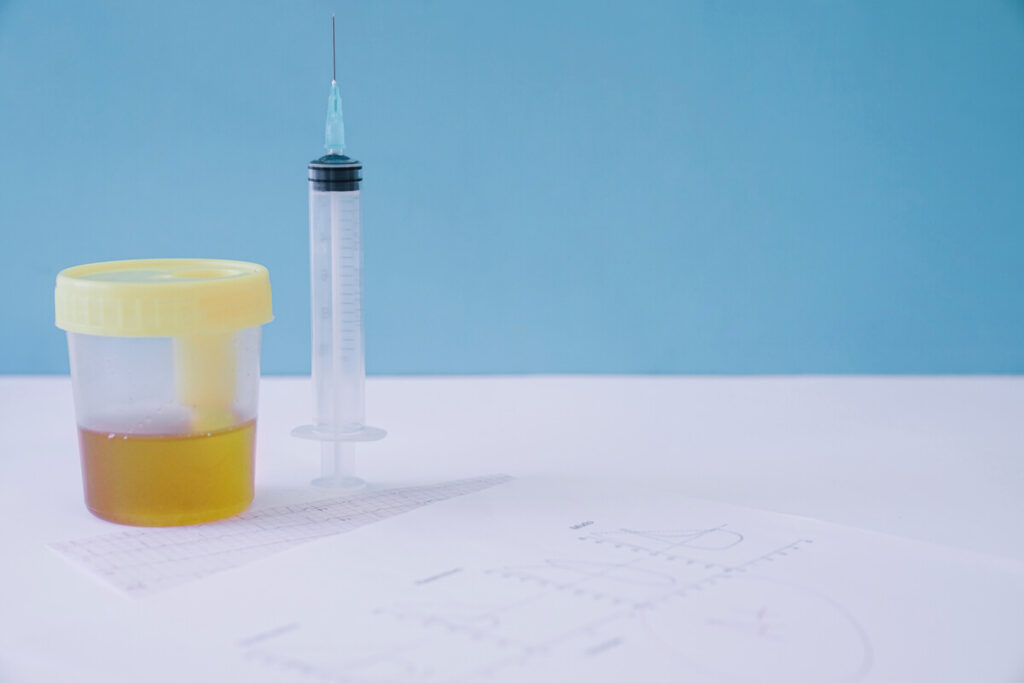 Durée d'un arrêt maladie pour infection urinaire : ce qu'il faut savoir 4 Un flacon d'analyse d'urine prêt pour un examen cytobactériologique en laboratoire.