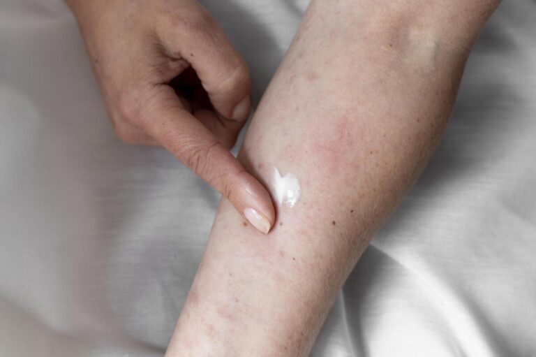 Application délicate d'une crème réparatrice sur une cicatrice de brûlure pour en atténuer l'aspect.