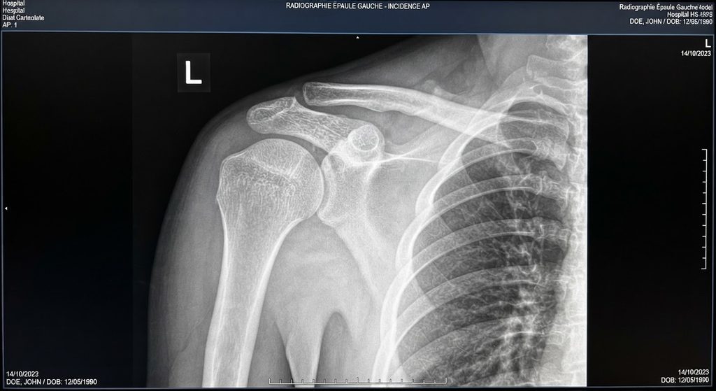 Trame osseuse homogène : signification, radiographie et santé des os 3