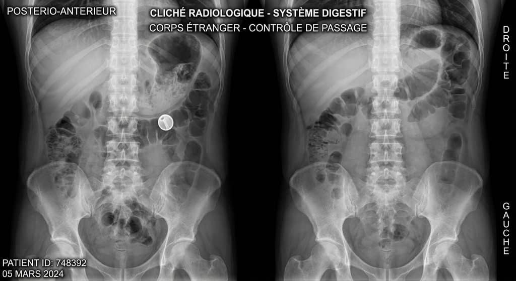 Cliché radiologique du système digestif pour contrôler le passage d'un corps étranger.