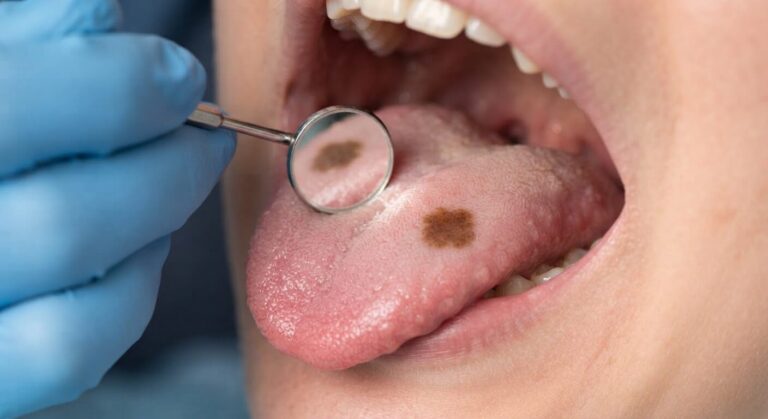 Macule pigmentée brune bénigne sur la face dorsale de la langue examinée au miroir.