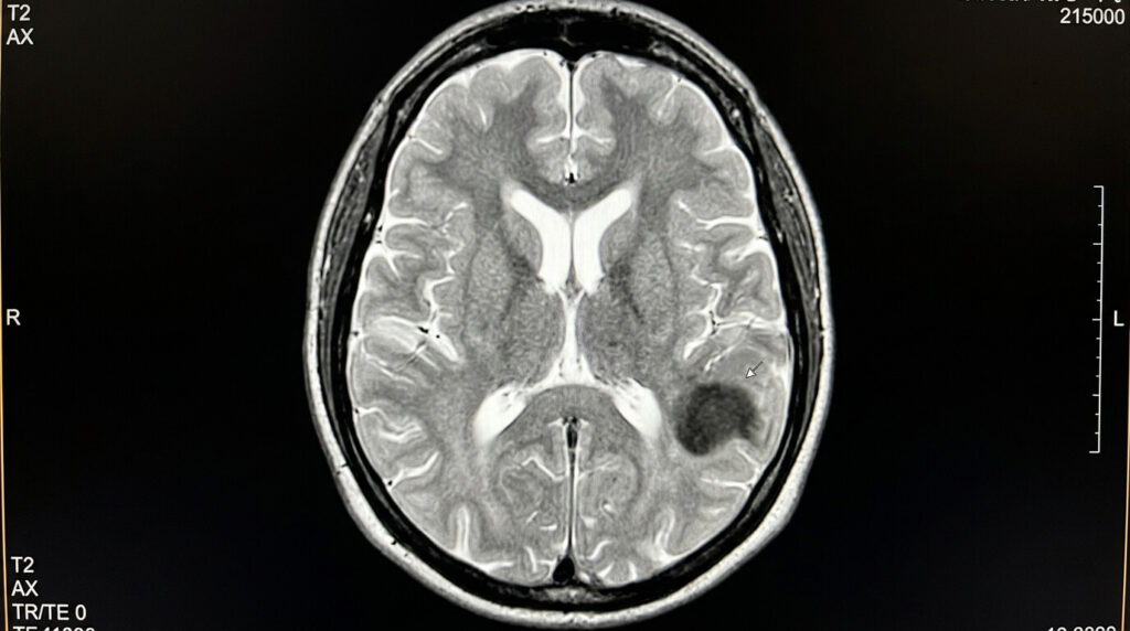 Hyposignal T2 en IRM : définition médicale, causes et signification 2 Cliché d'imagerie par résonance magnétique en séquence T2 montrant une zone d'hyposignal sombre.
