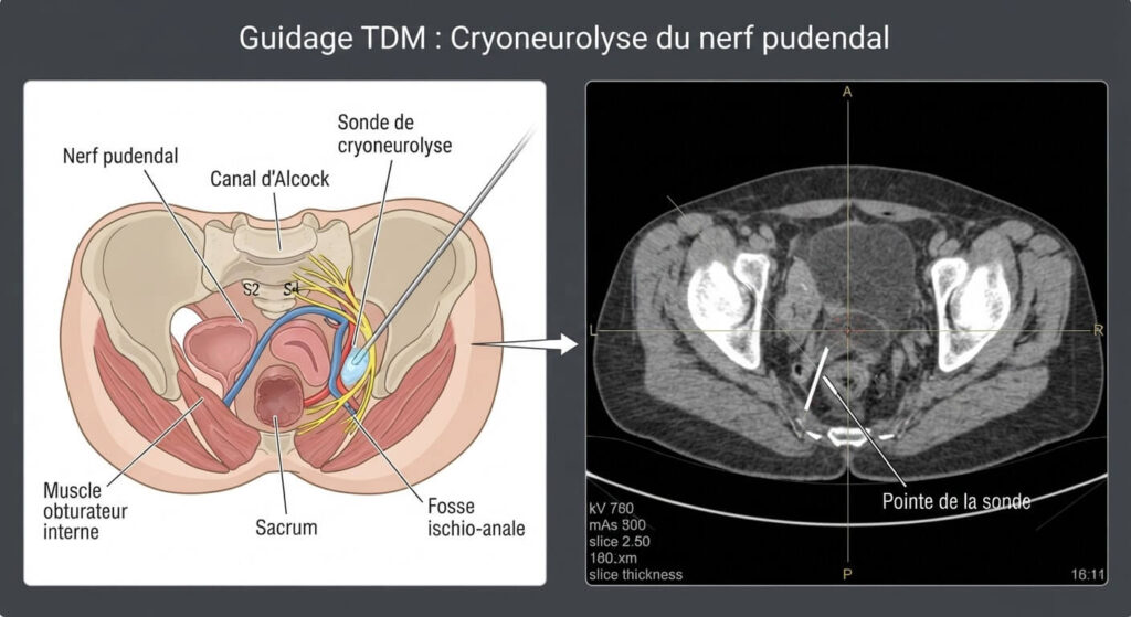 Cryoneurolyse du nerf pudendal : avis, efficacité réelle et retours d'expérience 2 Guidage par imagerie scanner de la sonde de cryoneurolyse vers le trajet du nerf pudendal.