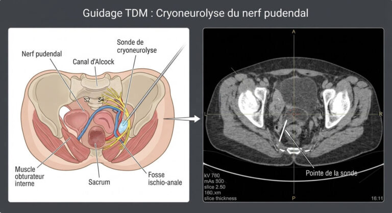 Accueil 1 Guidage par imagerie scanner de la sonde de cryoneurolyse vers le trajet du nerf pudendal.