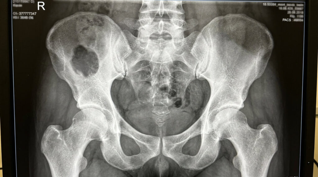 Cliché radiologique du bassin montrant une zone de lacune osseuse radiotransparente plus sombre.