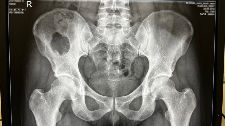 Cliché radiologique du bassin montrant une zone de lacune osseuse radiotransparente plus sombre.
