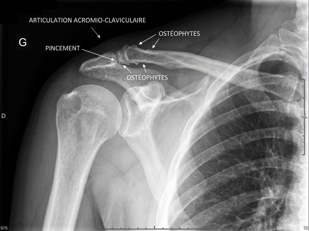 Radiographie d'une épaule montrant un pincement et des ostéophytes de l'articulation acromio-claviculaire.