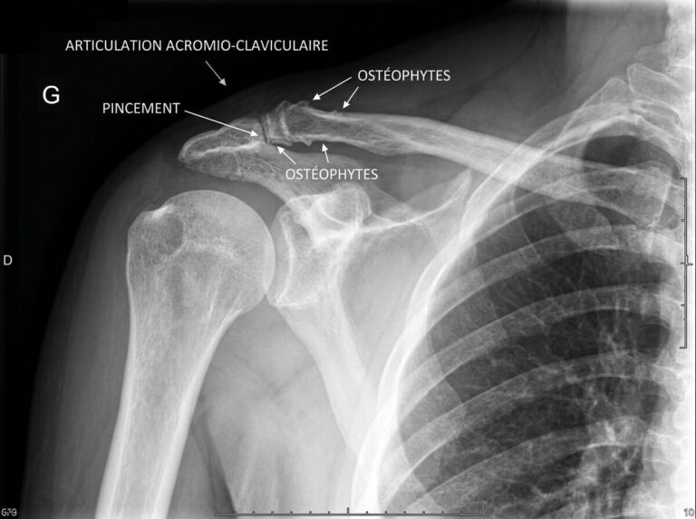 Radiographie d'une épaule montrant un pincement et des ostéophytes de l'articulation acromio-claviculaire.