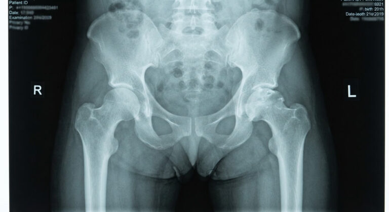 Radiographie du bassin d'un enfant montrant un aplatissement de la tête fémorale.