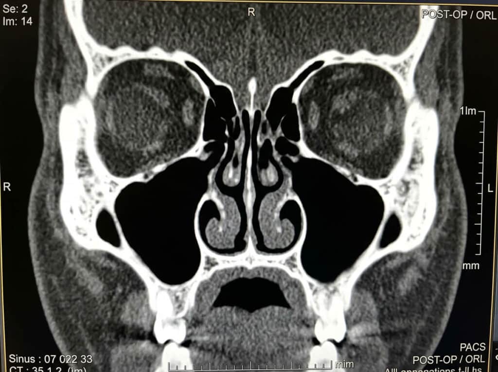 Syndrome du nez vide : témoignage de patients, symptômes et avis de la HAS 2 Scanner ORL montrant des cavités nasales excessivement élargies après résection des cornets inférieurs.